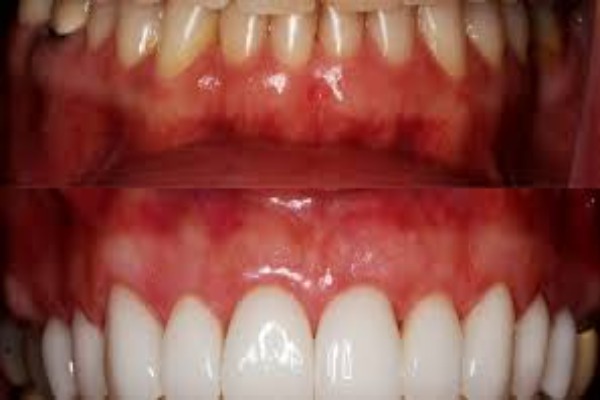 Diş Eti Sağlığı Neden Bu Kadar Önemli? Diş Eti Çekilmesi, Kanama ve Korunma Yolları