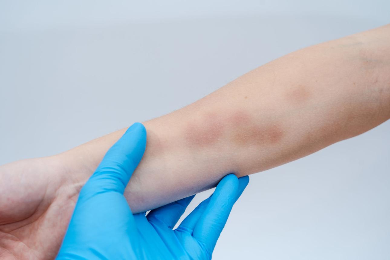 Vücutta Morluk Neden Oluşur? Ne Zaman Tehlikeli Olabilir?