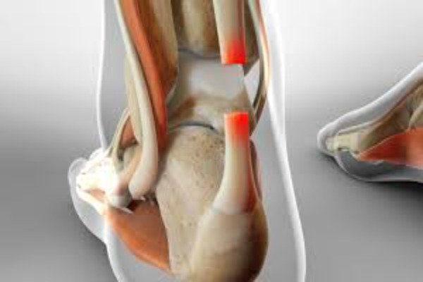 Tendon Rüptürü Nedir? Belirtileri, Nedenleri ve Tedavi Seçenekleri